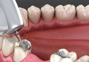 دنت منت - فروشگاه آنلاین کالای دندانپزشکی - 1