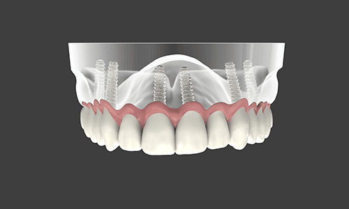 دنت منت - فروشگاه آنلاین کالای دندانپزشکی - overdenture