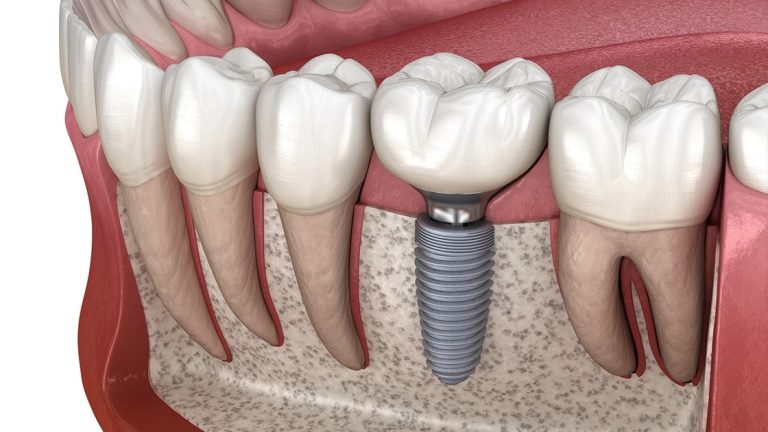 دنت منت - فروشگاه آنلاین کالای دندانپزشکی - IMPLANT1 D.M