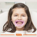 دهان بازکن اوپتراگیت بدون لاتکس OptraGate 3D OptraGate Retractors - تصویر 2